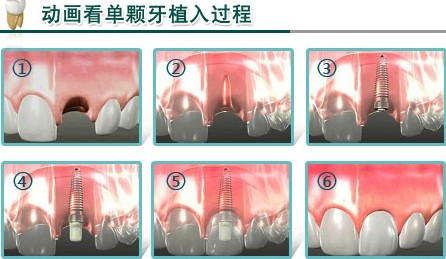 种植动画演示