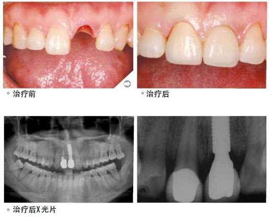 治疗后X光片