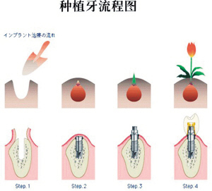 种植牙流程图